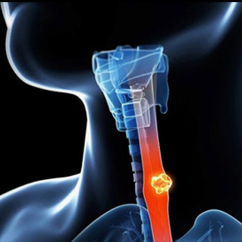 Esophageal_cancer